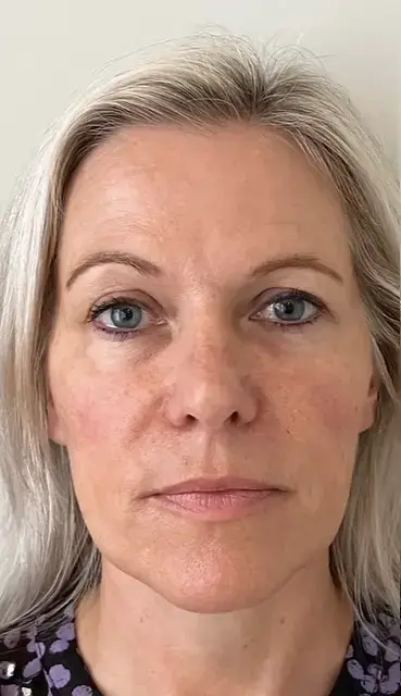 Dame liquid facelift2 NA