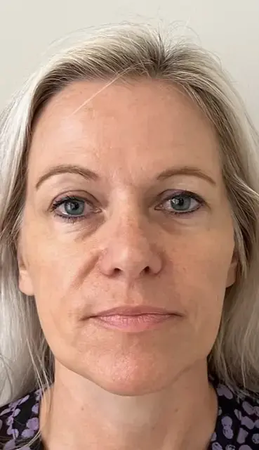 Dame liquid facelift2 VOOR